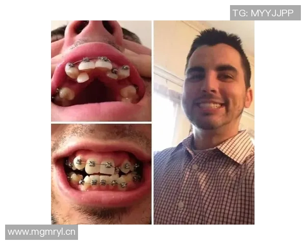 亚马尔自信分享戴牙套体验称其外观与自我形象完美契合 亚马尔自信分享戴牙套体验称其外观与自我形象完美契合